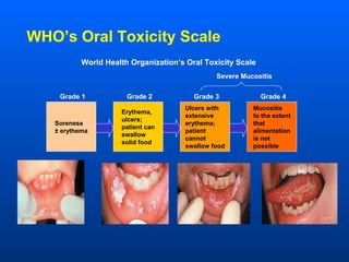Mucositis oral Slide 7