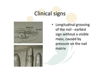 Clinical signs
       • Longitudinal grooving
         of the nail - earliest
         sign without a visible
         mass, caused by
         pressure on the nail
         matrix
 
