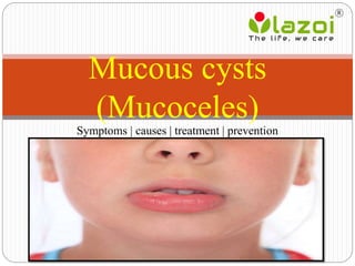 Symptoms | causes | treatment | prevention
Mucous cysts
(Mucoceles)
 