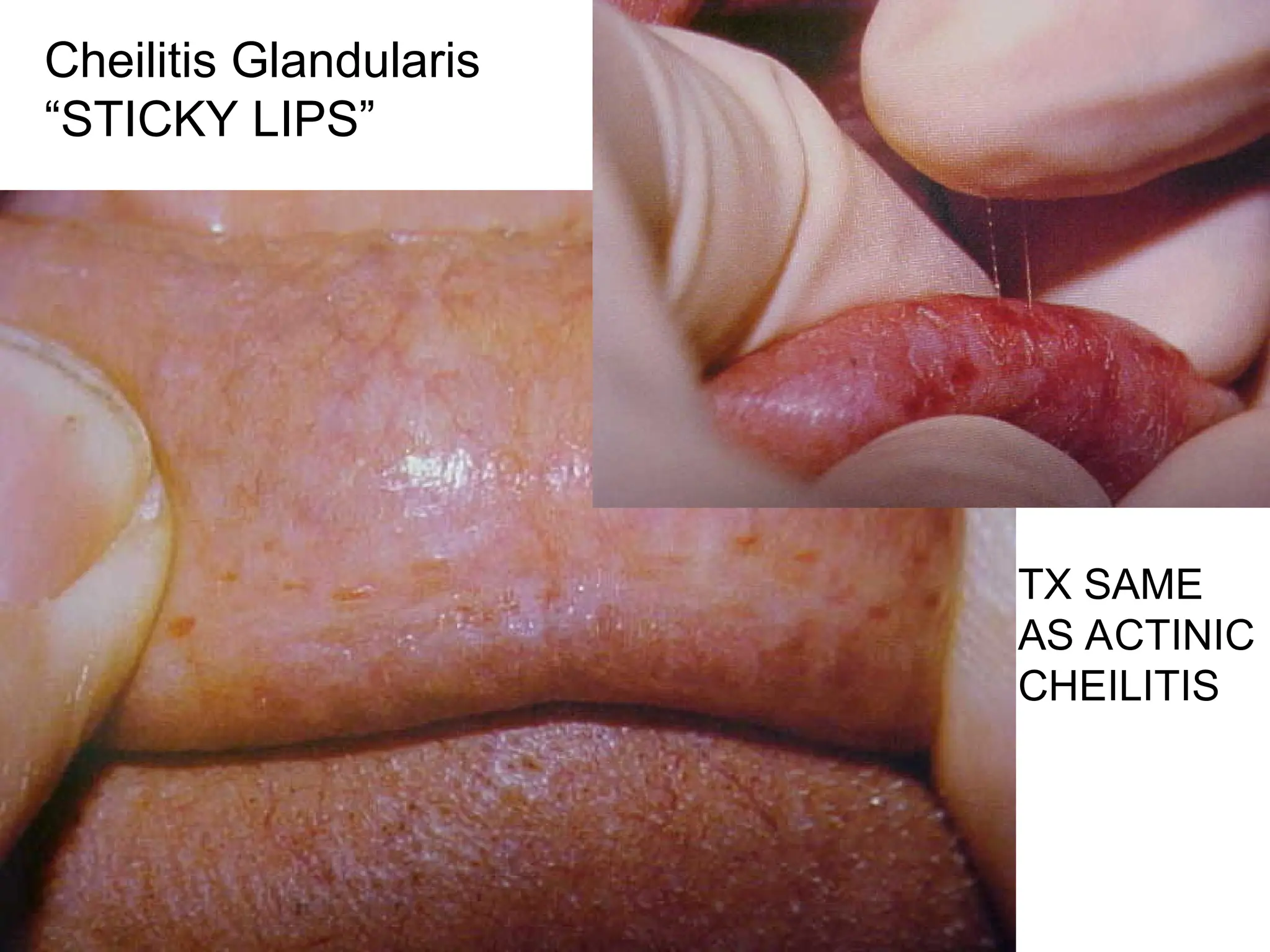 Cheilitis Glandularis
“STICKY LIPS”
TX SAME
AS ACTINIC
CHEILITIS
 