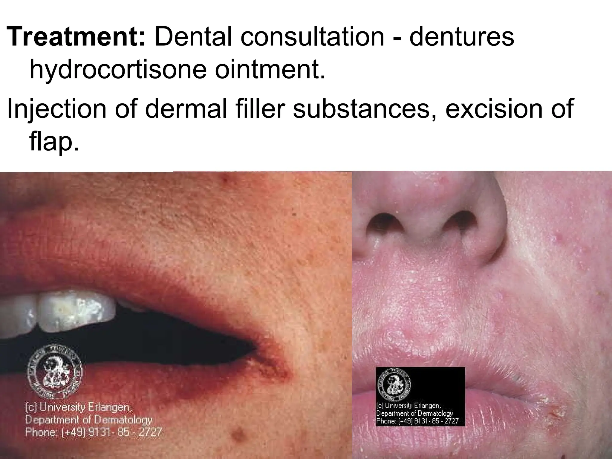 Treatment: Dental consultation - dentures
hydrocortisone ointment.
Injection of dermal filler substances, excision of
flap.
 