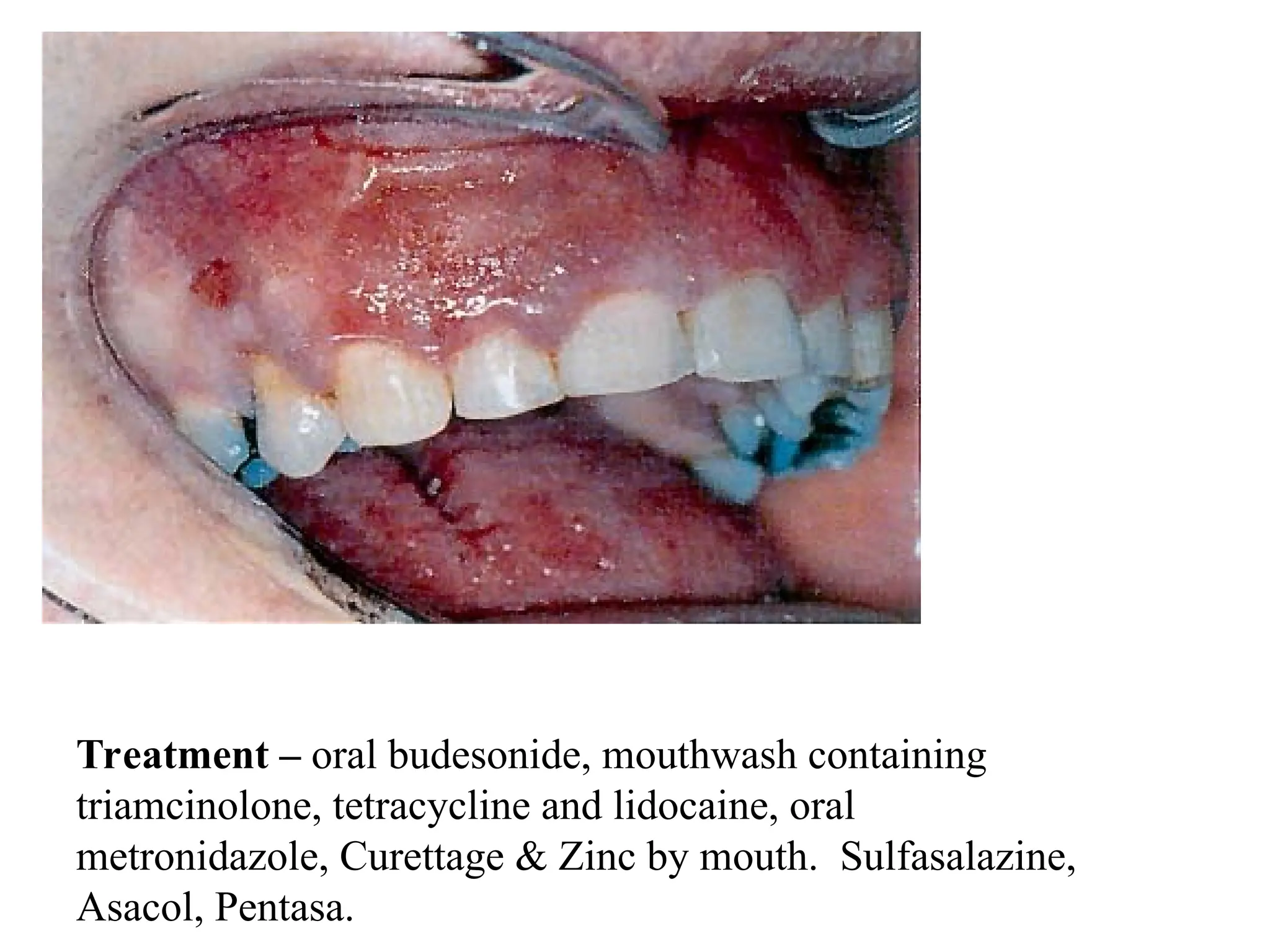 Treatment – oral budesonide, mouthwash containing
triamcinolone, tetracycline and lidocaine, oral
metronidazole, Curettage & Zinc by mouth. Sulfasalazine,
Asacol, Pentasa.
 