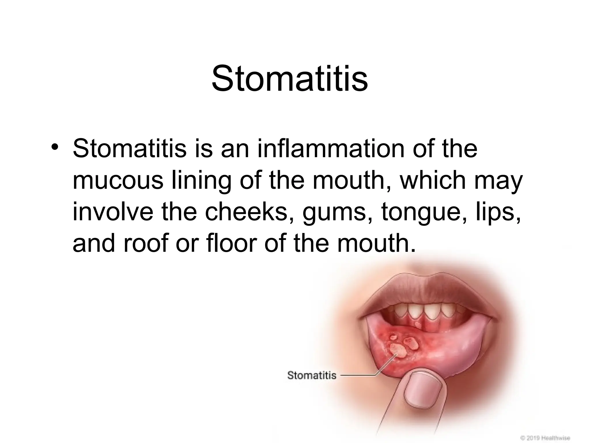 Stomatitis
• Stomatitis is an inflammation of the
mucous lining of the mouth, which may
involve the cheeks, gums, tongue, lips,
and roof or floor of the mouth.
 