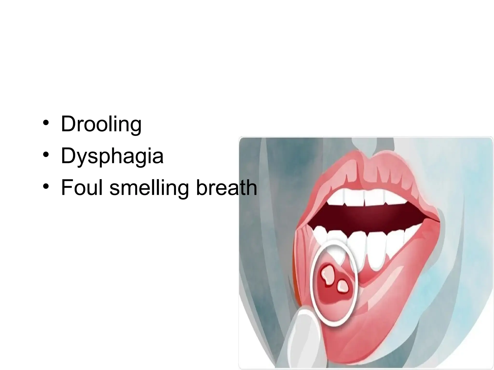• Drooling
• Dysphagia
• Foul smelling breath
 