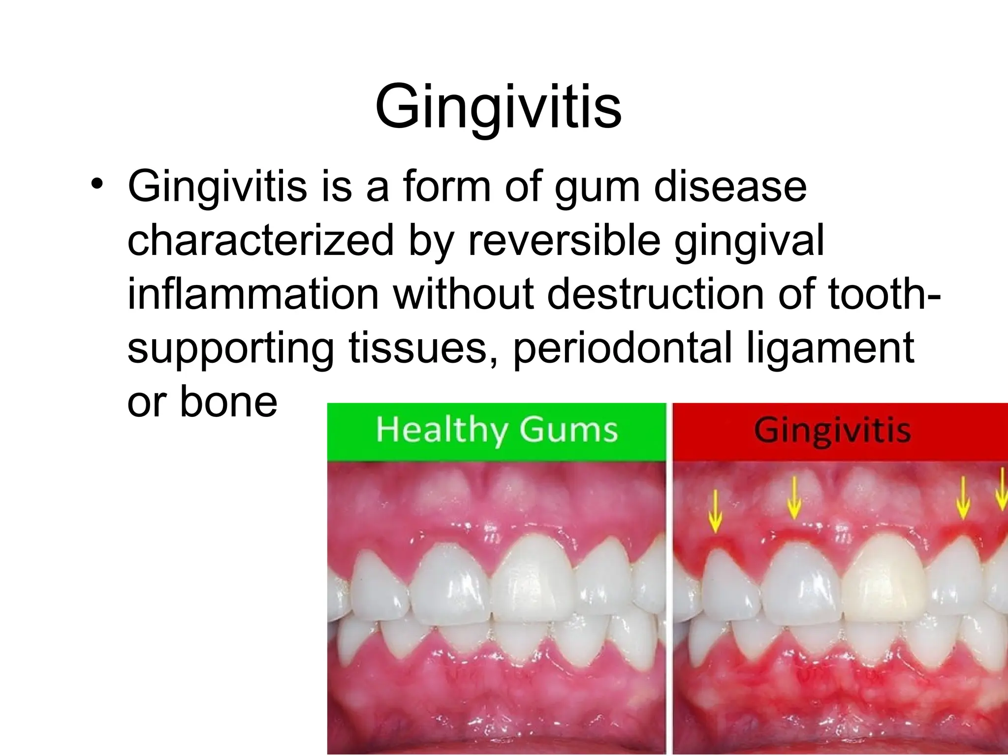 Gingivitis
• Gingivitis is a form of gum disease
characterized by reversible gingival
inflammation without destruction of tooth-
supporting tissues, periodontal ligament
or bone
 