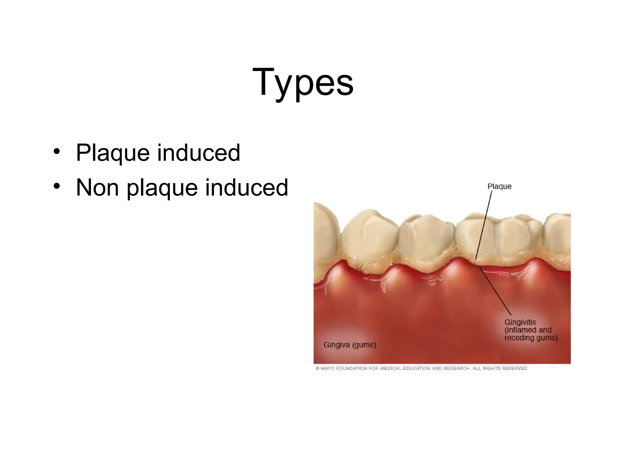 Types
• Plaque induced
• Non plaque induced
 