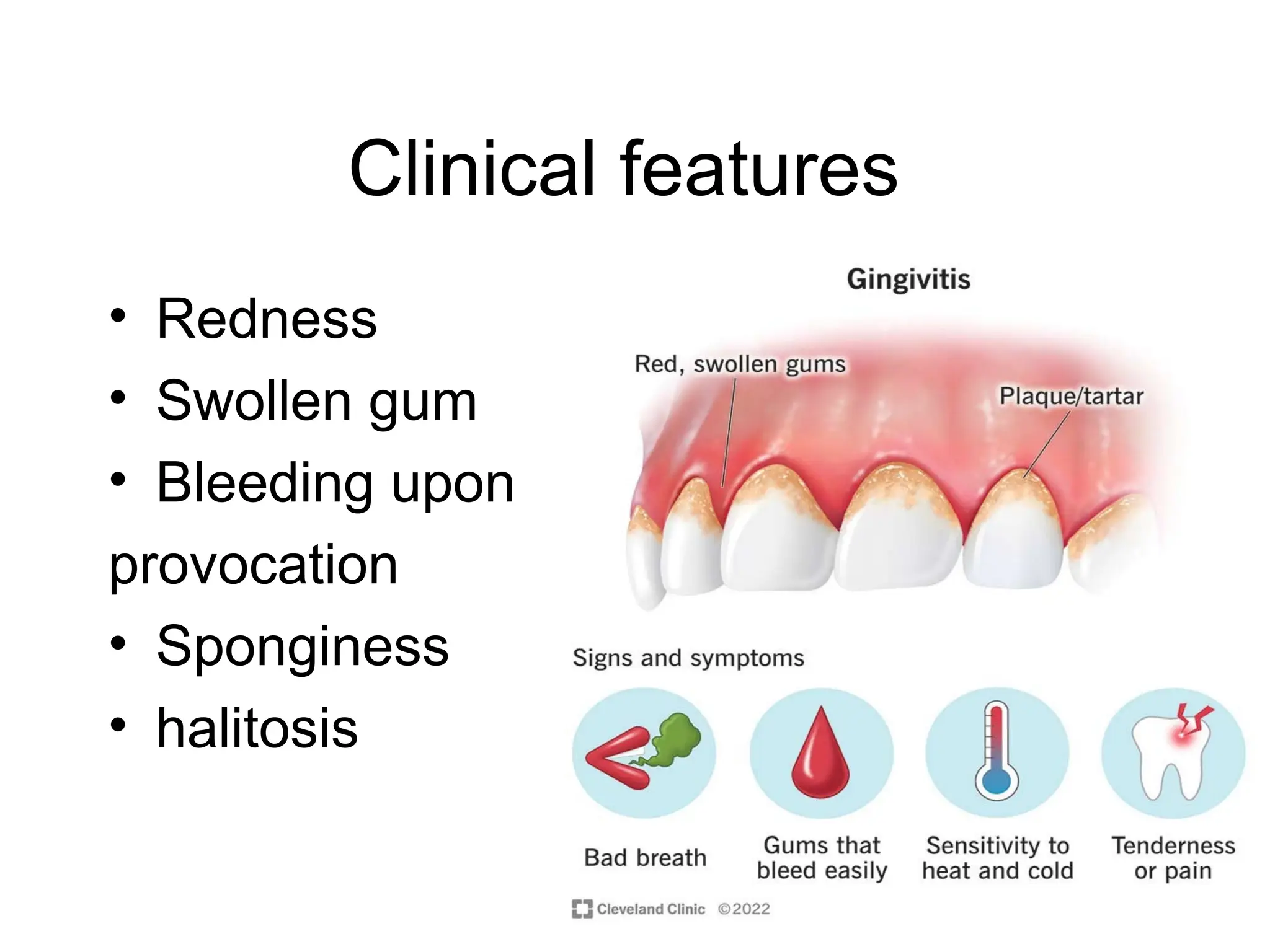 Clinical features
• Redness
• Swollen gum
• Bleeding upon
provocation
• Sponginess
• halitosis
 