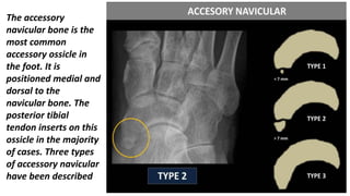 Accessory Navicular Injection Muculoskeletal Pediatic Imaging..pptx