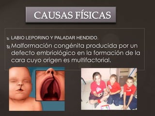    LABIO LEPORINO Y PALADAR HENDIDO.
   Malformación congénita producida por un
    defecto embriológico en la formación de la
    cara cuyo origen es multifactorial.
 