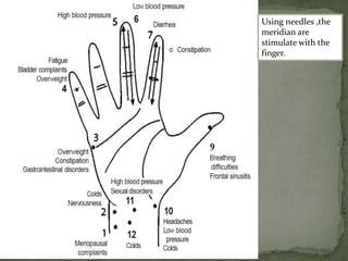 Using needles ,the
meridian are
stimulate with the
finger.
 
