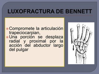  Compromete    la articulación
  trapeciocarpian,
 Una porción se desplaza
  radial y proximal por la
  acción del abductor largo
  del pulgar
 