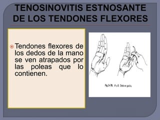  Tendones  flexores de
 los dedos de la mano
 se ven atrapados por
 las poleas que lo
 contienen.
 