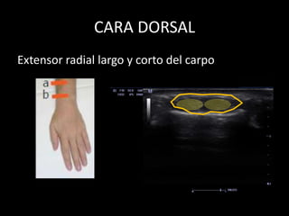 CARA DORSAL
Extensor radial largo y corto del carpo

 