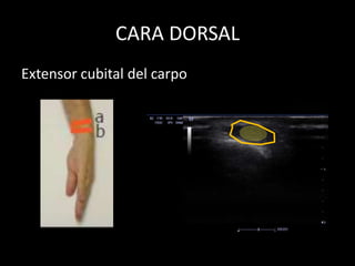 CARA DORSAL
Extensor cubital del carpo

 