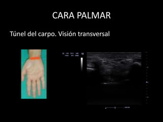 CARA PALMAR
Túnel del carpo. Visión transversal

 