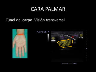 CARA PALMAR
Túnel del carpo. Visión transversal

 