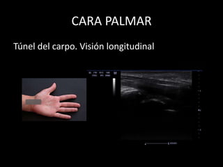 CARA PALMAR
Túnel del carpo. Visión longitudinal

 