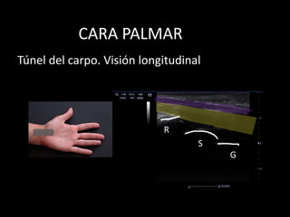CARA PALMAR
Túnel del carpo. Visión longitudinal

R
S
G

 