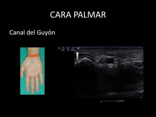 CARA PALMAR
Canal del Guyón

 