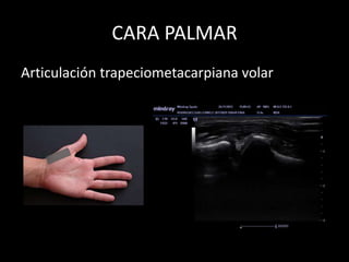 CARA PALMAR
Articulación trapeciometacarpiana volar

 