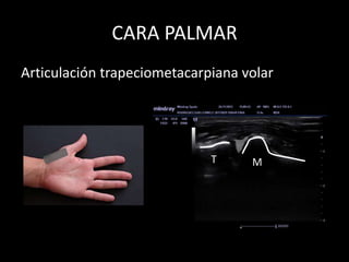 CARA PALMAR
Articulación trapeciometacarpiana volar

T

M

 
