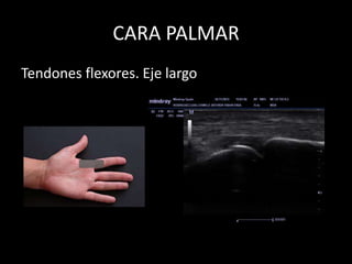 CARA PALMAR
Tendones flexores. Eje largo

 