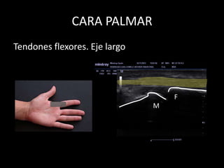 CARA PALMAR
Tendones flexores. Eje largo

F
M

 