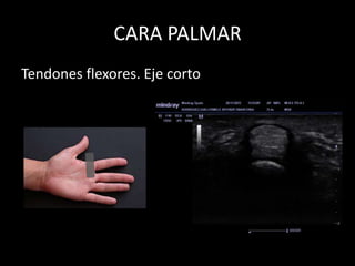 CARA PALMAR
Tendones flexores. Eje corto

 