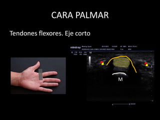 CARA PALMAR
Tendones flexores. Eje corto

M

 