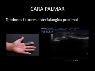CARA PALMAR
Tendones flexores. Interfalángica proximal

 