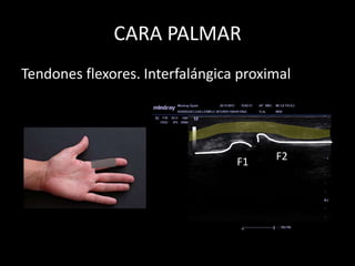 CARA PALMAR
Tendones flexores. Interfalángica proximal

F1

F2

 