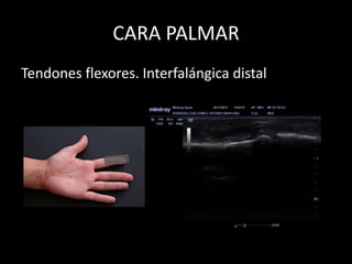 CARA PALMAR
Tendones flexores. Interfalángica distal

 