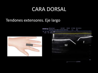 CARA DORSAL
Tendones extensores. Eje largo

M

F

 