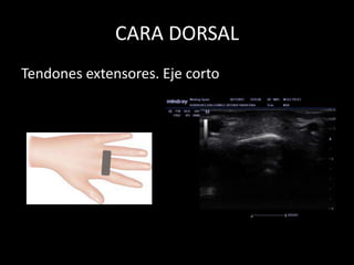 CARA DORSAL
Tendones extensores. Eje corto

 