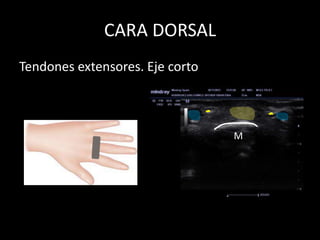 CARA DORSAL
Tendones extensores. Eje corto

M

 