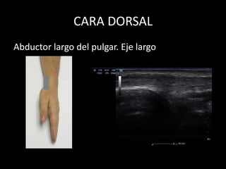 CARA DORSAL
Abductor largo del pulgar. Eje largo

 