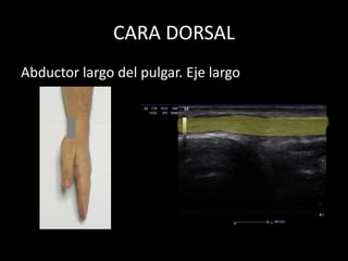 CARA DORSAL
Abductor largo del pulgar. Eje largo

 
