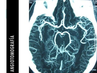 ANGIOTOMOGRAFÍA 
 