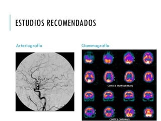 ESTUDIOS 
RECOMENDADOS 
Arteriografía Gammagrafía 
 