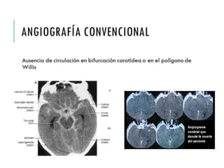 ANGIOGRAFÍA 
CONVENCIONAL 
Ausencia de circulación en bifurcación carotídea o en el 
polígono de Willis 
 