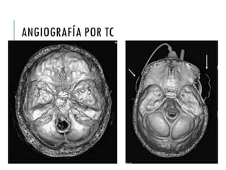 ANGIOGRAFÍA POR TC 
 