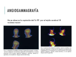 ANGIOGAMMAGRAFÍA 
No se observa la captación del Tc-99 por el tejido 
cerebral  «cráneo vacío» 
 