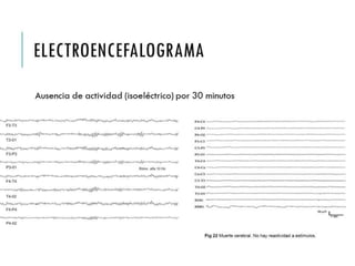 ELECTROENCEFALOGRA 
MA 
Ausencia de actividad (isoeléctrico) por 30 minutos 
 