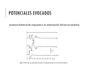 POTENCIALES 
EVOCADOS 
Ausencia bilateral de respuesta a la estimulación del 
nervio mediano 
 