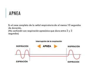 APNEA 
Es el cese completo de la señal respiratoria de al menos 
10 segundos de duración. 
(No confundir con respiración apneúsica que dura entre 2 
y 3 segundos) 
 
