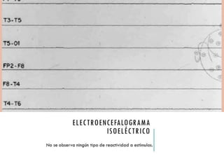 ELECTROENCEFALOG 
RAMA ISOELÉCTRICO 
No se observa ningún tipo de reactividad a 
estímulos. 
 