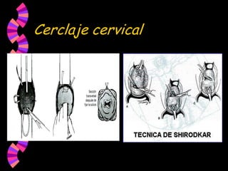 Cerclaje cervical