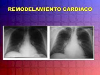 REMODELAMIENTO CARDIACO
 