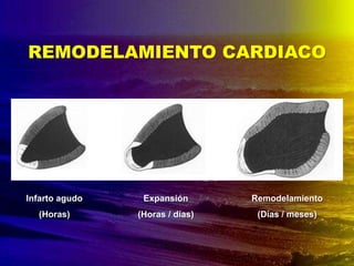 Infarto agudo
(Horas)
Expansión
(Horas / días)
Remodelamiento
(Días / meses)
REMODELAMIENTO CARDIACO
 