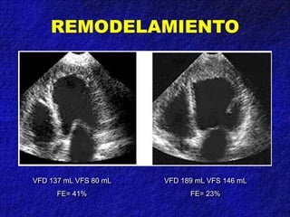 REMODELAMIENTO
VFD 137 mL VFS 80 mL
FE= 41%
VFD 189 mL VFS 146 mL
FE= 23%
 